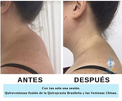 Cifosis Cervical. Este caso mejoró en una sesión de una hora