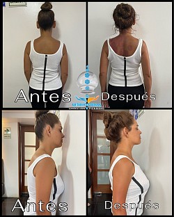 Mala postura, desviación de columna y estrés. Este caso se pudo hacer en tan solo una sesión y en una hora.