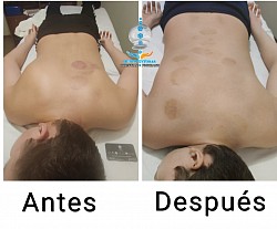 Escoliosis. Un mejoramiento a un 85% con 15 sesiones